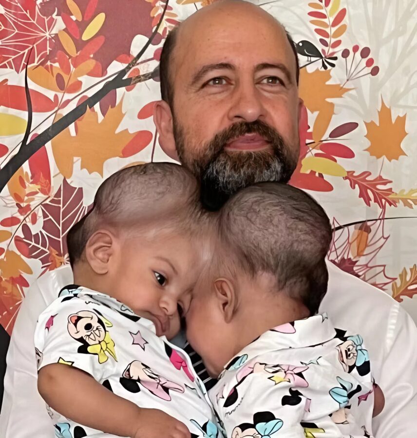 Systrarna föddes med ett gemensamt huvud, men när de var 3 år gamla separerade läkarna dem: så här ser de ut idag